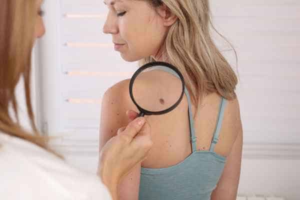 What Are Traditional Skin Lesion Removal Methods Skegness?