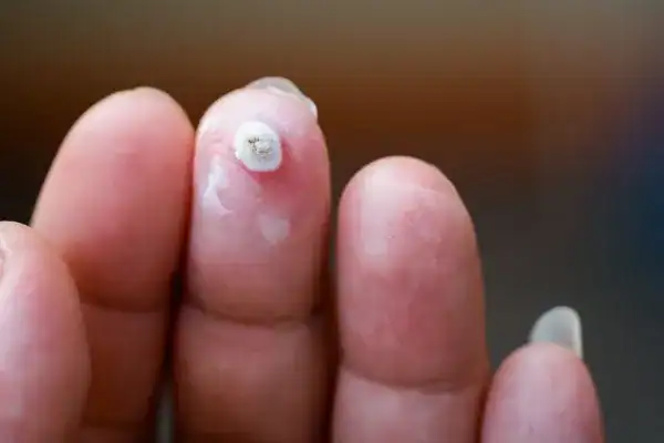 Image of white wart before cryopen treatment Skegness