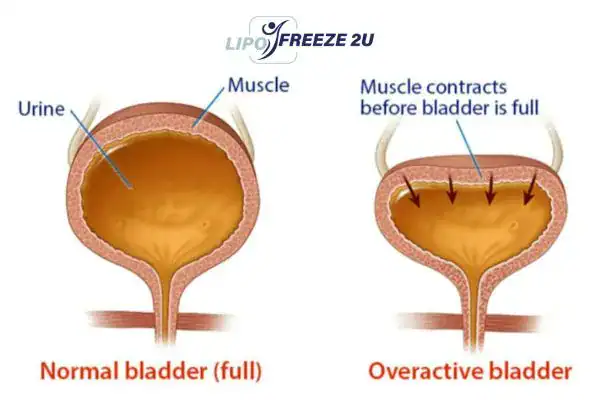 diagram of overactive bladder treatment Skegness