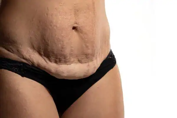 loose skin after weight loss injections Skegness