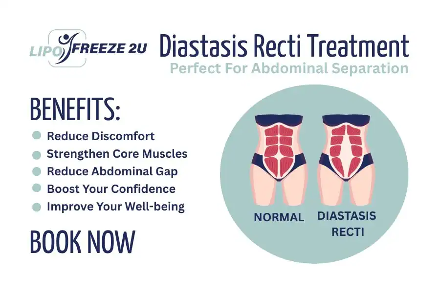 How Long Will It Take to See Improvements in Diastasis Recti Skegness