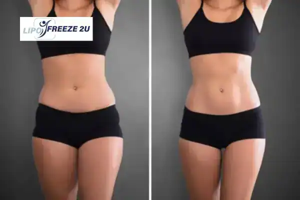 How Can LIPO FREEZE 2U Support Your Post-Pregnancy Body Recovery Skegness?