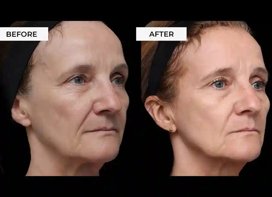 How Many RF Microneedling Sessions Will You Need to See a Difference Skegness?