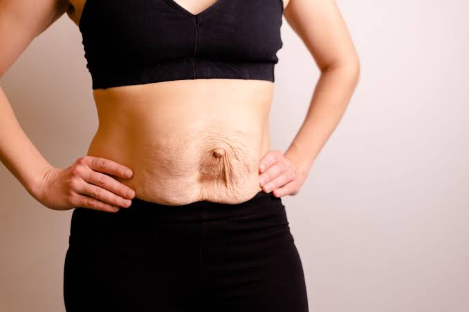 Is Surgery Really the Only Way to Repair Diastasis Recti Skegness?