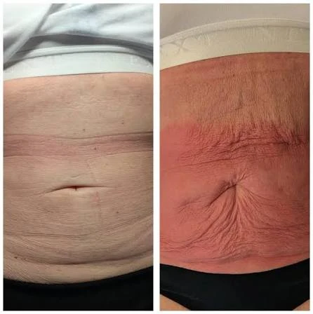 How Does RF Microneedling Improve Crepey, Thin and Uneven Skin Texture Skegness?